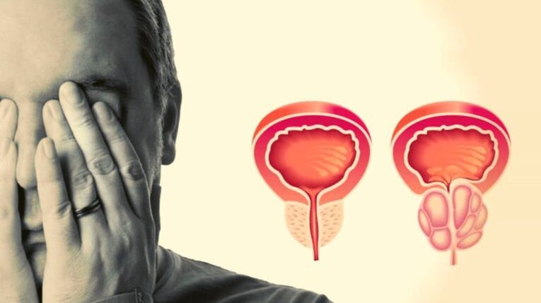 A man has prostatitis