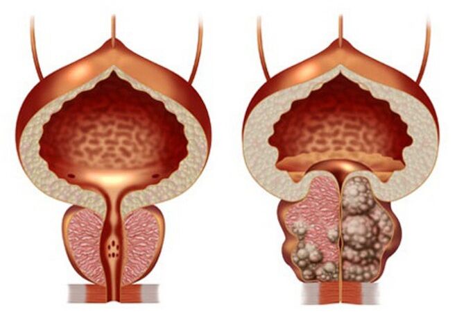 healthy prostate and prostatic adenoma