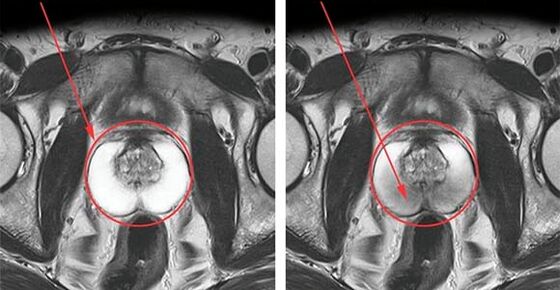 Normal prostate (left) and inflamed prostate with prostatitis (right)